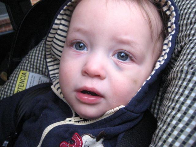 Baby's first black eye ~ February 19, 2010