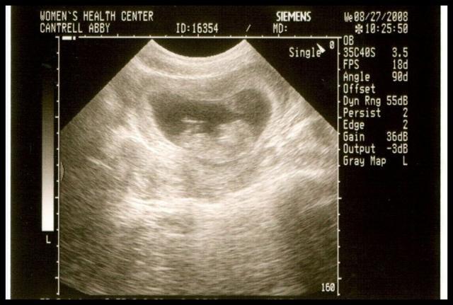 Pic of the Week ~ 8/31/08 (11 week ultrasound)