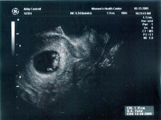 7 week ultrasound ~ A little blob now, with a heartbeat of 162 beats per minute!