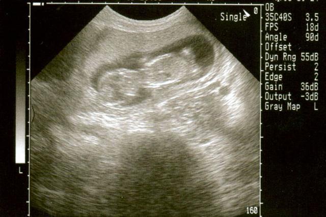 13 week ultrasound