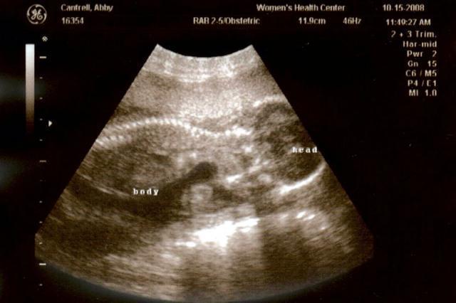 18 week ultrasound