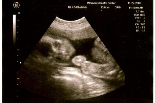 24 week ultrasound - face and arm