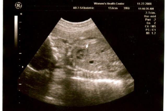24 week ultrasound - heart