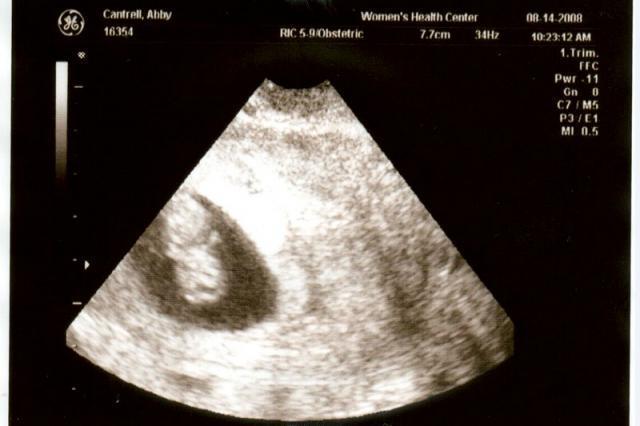 9 week ultrasound
